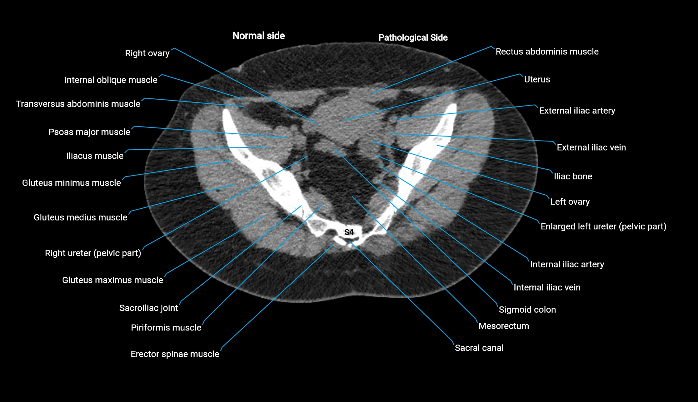 CT KUB axial cross sectional anatomy  radiology image -img-00201-00133.webp